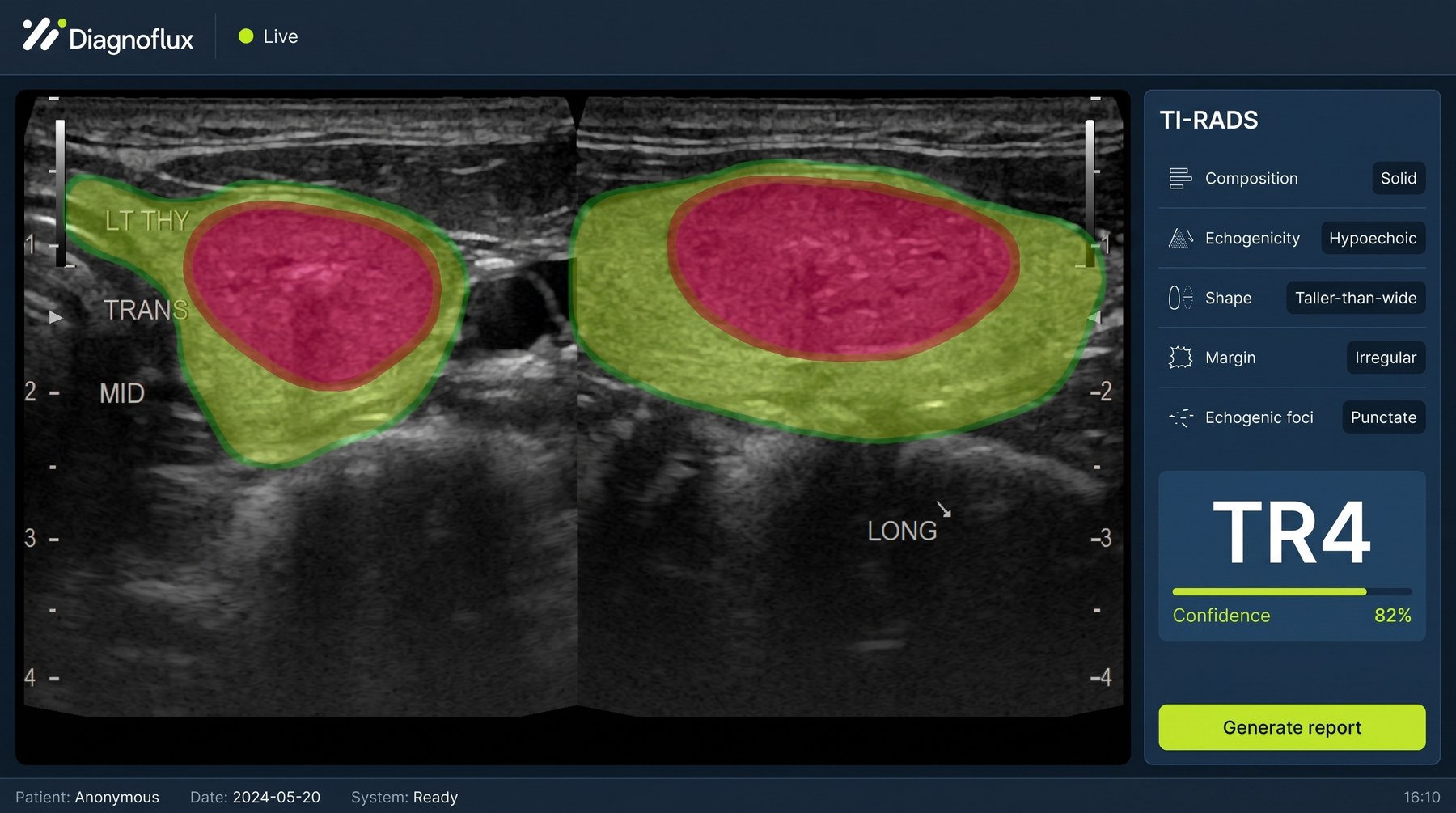 The Diagnoflux interface: a dual-plane thyroid ultrasound with nodule and gland segmentation, a per-component TI-RADS breakdown, and a TR4 result at 82 percent confidence
